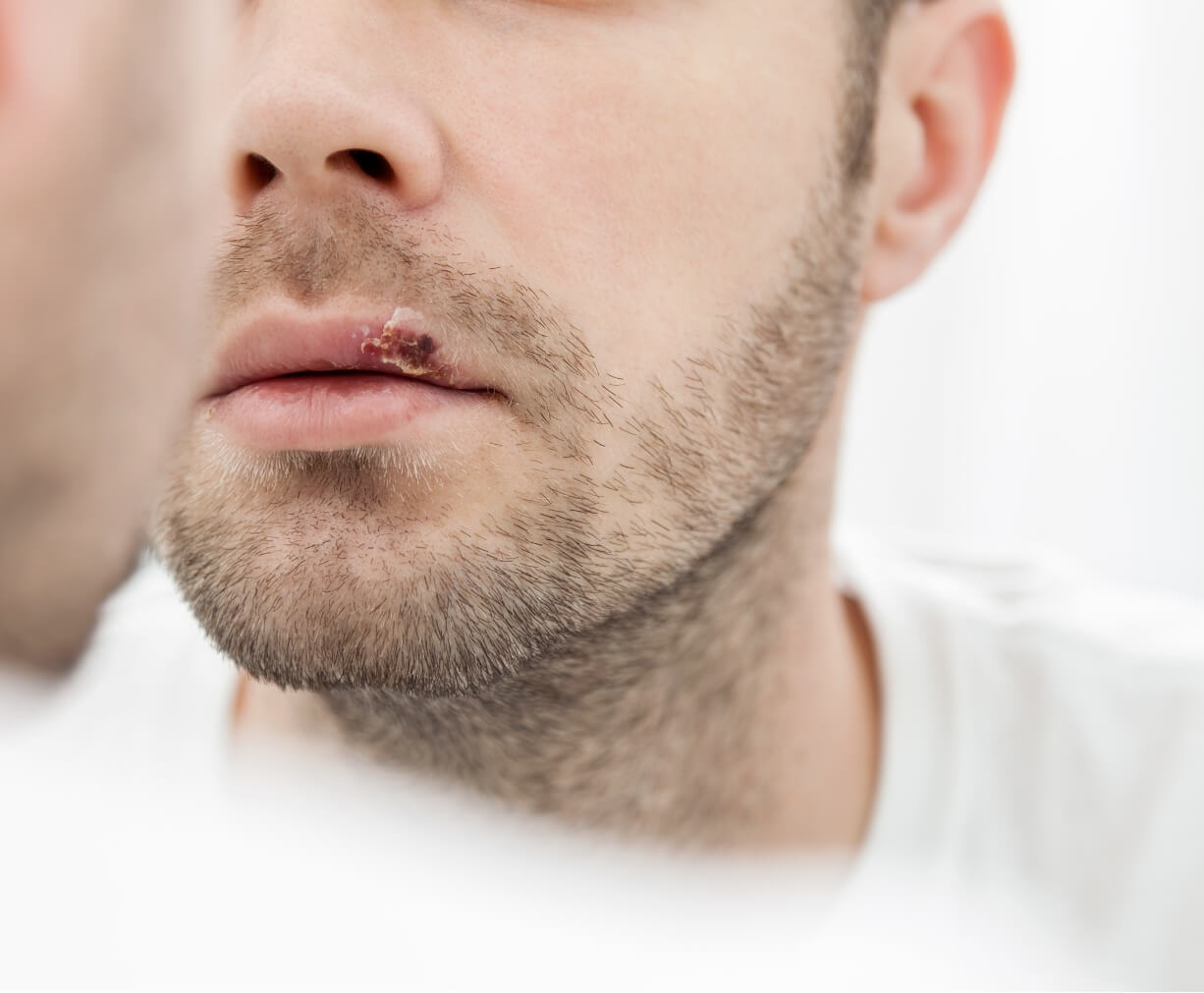young-man-suffering-from-herpes-on-his-mouth-2023-11-27-05-17-45-utc (1) (1)